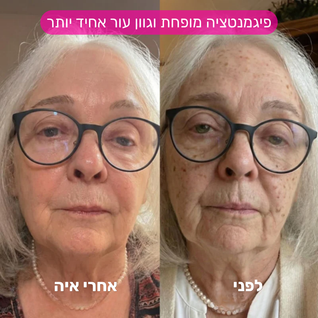מערכת המיקרונידלינג