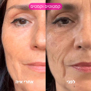 מערכת המיקרונידלינג