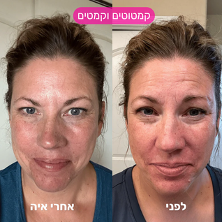 מערכת המיקרונידלינג