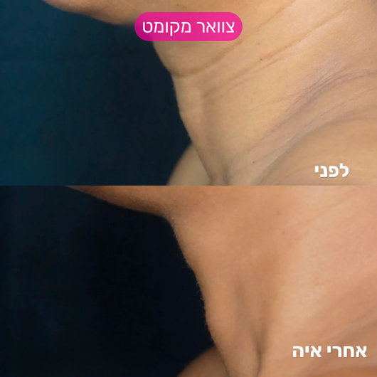 מערכת המיקרונידלינג